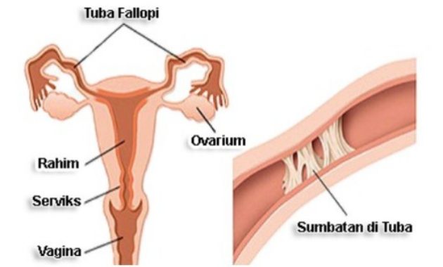 √ Tuba Fallopi : Pengertian, Fungsi, Struktur dan Penyebab Terlengkap