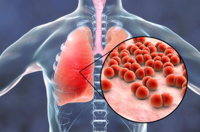 √ Pneumonia : Pengertian, Gejala, Pencegahan dan Pengobatan Terlengkap
